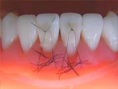 歯周再生治療～カンガルーテクニック～