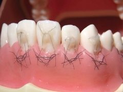 歯周再生治療～カンガルーテクニック～