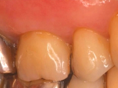歯周再生治療～カンガルーテクニック～術後