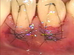 歯周再生治療～カンガルーテクニック～術前