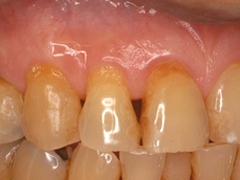 
歯周再生治療～パッチテクニック～治療前