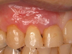 歯周再生治療～パッチテクニック～治療後